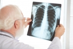 Estudo demonstra potencial de novo tratamento oral para o câncer de pulmão 